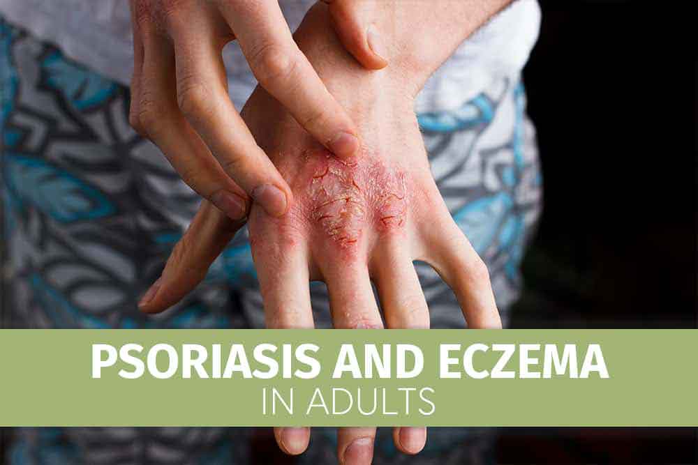 psoriasis1-1